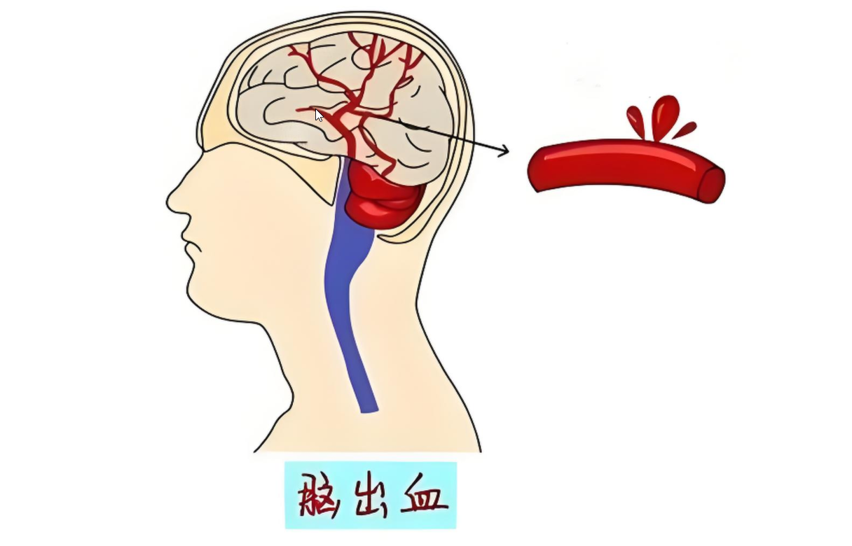 脑溢血是否属于重大疾病理赔范围？全面解析与投保建议